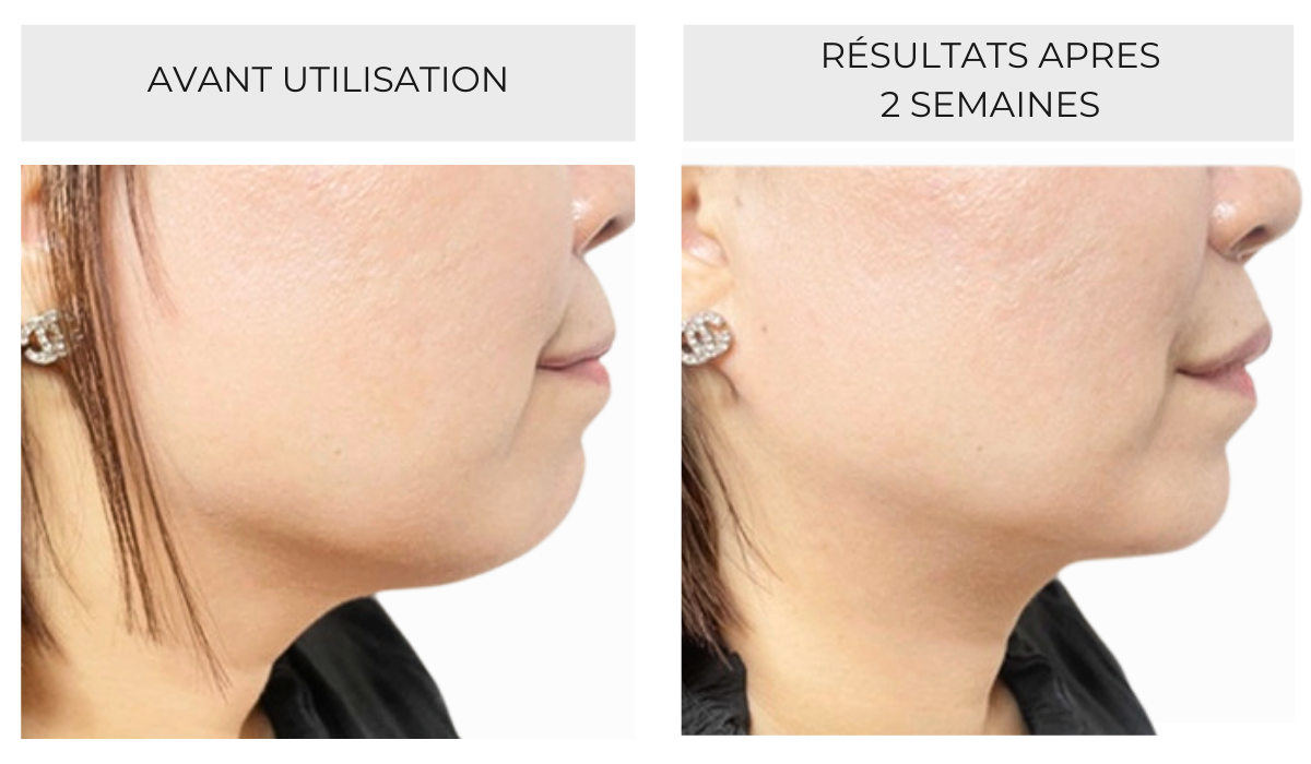 Avant après masque amincissant visage Hello Sculpt – réduction du double menton en 2 semaines